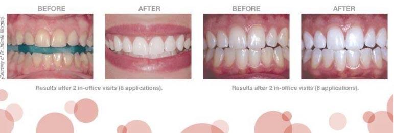 how to use opalescence tooth whitening