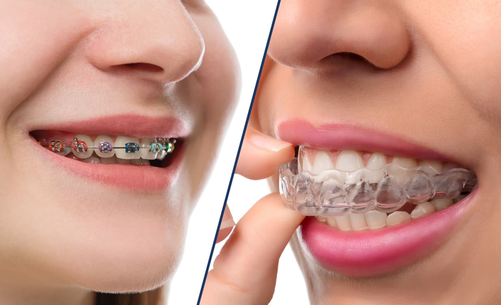 The Advantages of Invisalign Over Metal Braces