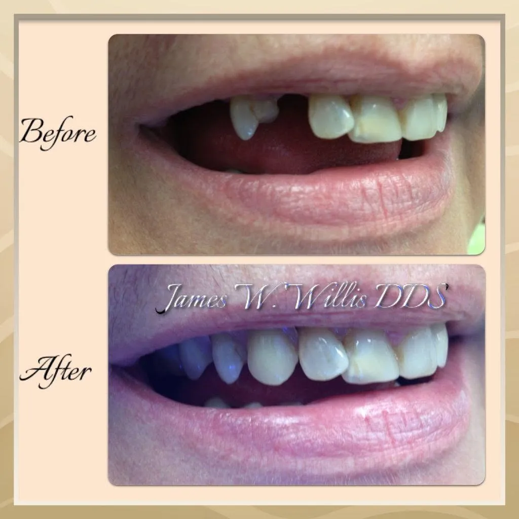 Before-and-after smile transformation — case 1, a cosmetic case treated by Dr. James Willis