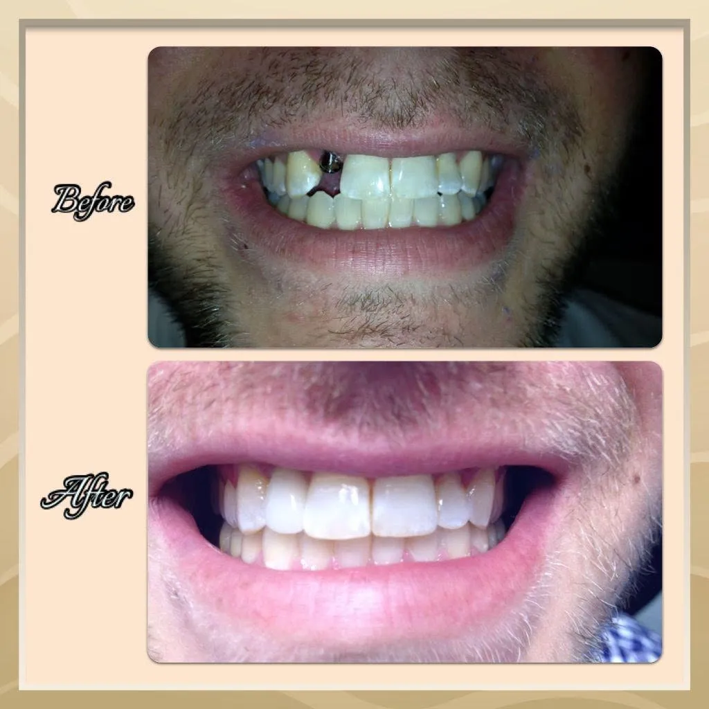 Before-and-after smile transformation — case 2, a cosmetic case treated by Dr. James Willis