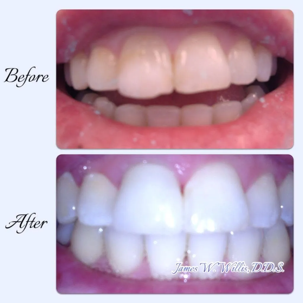 Before-and-after smile transformation — case 3, a cosmetic case treated by Dr. James Willis
