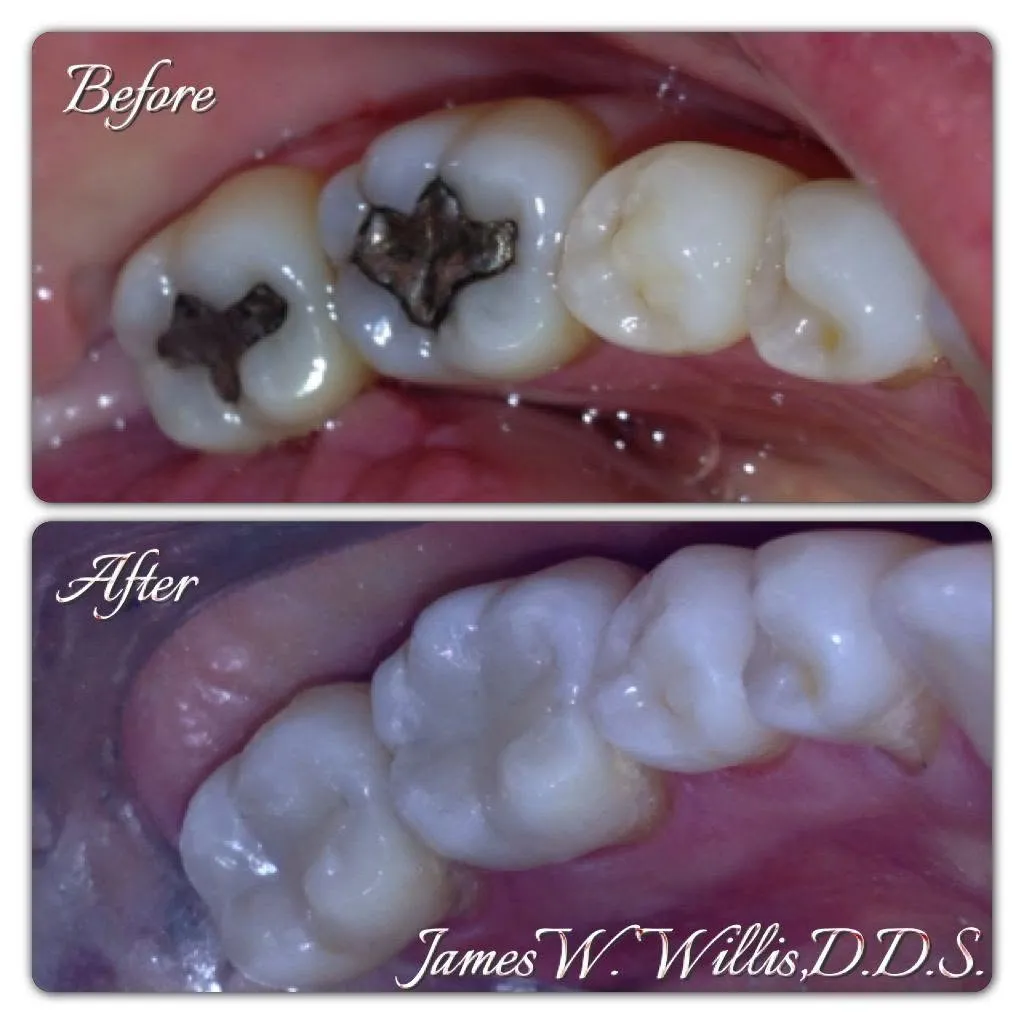 Before-and-after smile transformation — case 4, a cosmetic case treated by Dr. James Willis