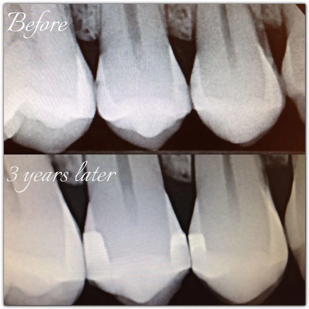 Before-and-after smile transformation — case 5, a cosmetic case treated by Dr. James Willis