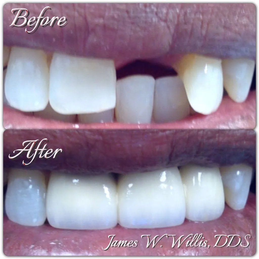 Before-and-after smile transformation — case 6, a cosmetic case treated by Dr. James Willis