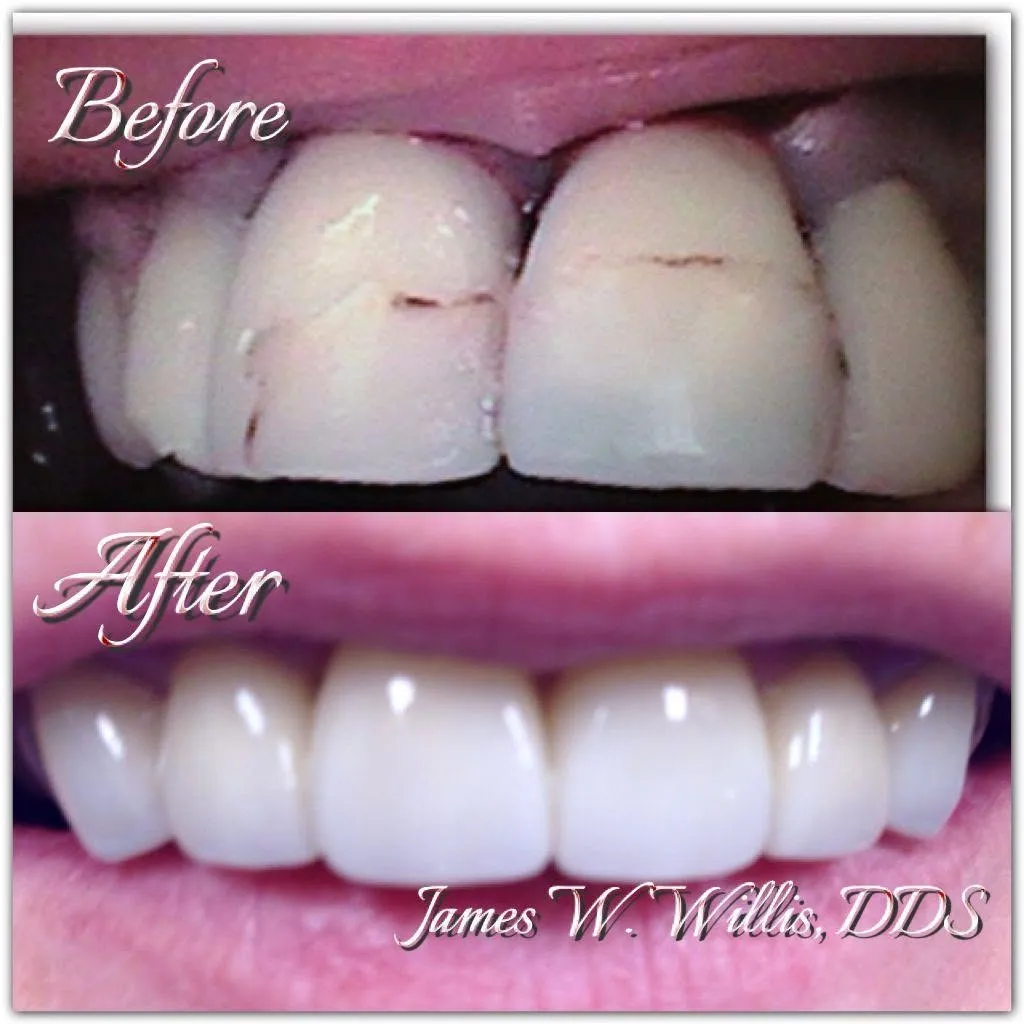 Before-and-after smile transformation — case 7, a cosmetic case treated by Dr. James Willis
