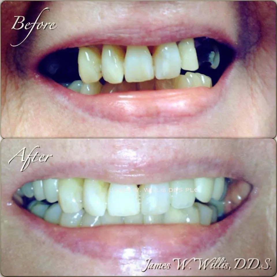 Before-and-after smile transformation — case 8, a cosmetic case treated by Dr. James Willis
