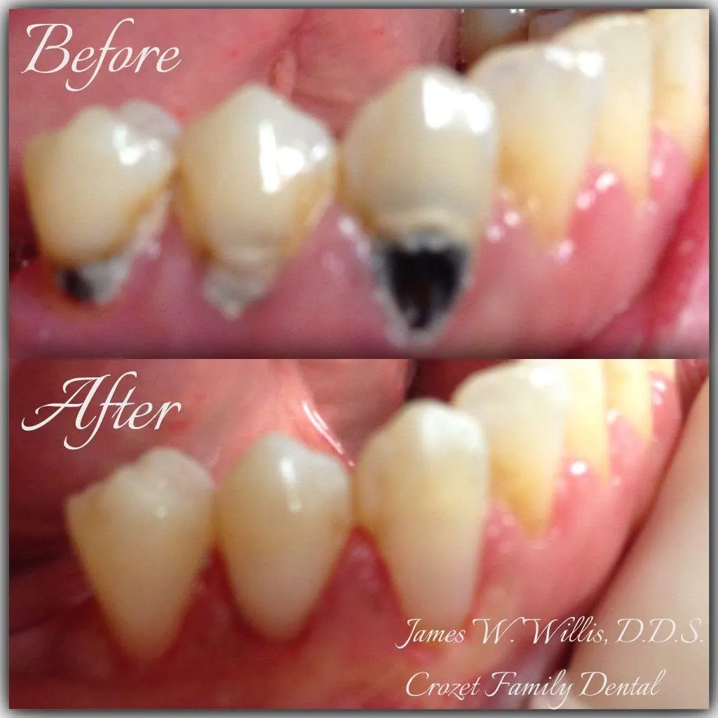 Before-and-after smile transformation — case 9, a cosmetic case treated by Dr. James Willis