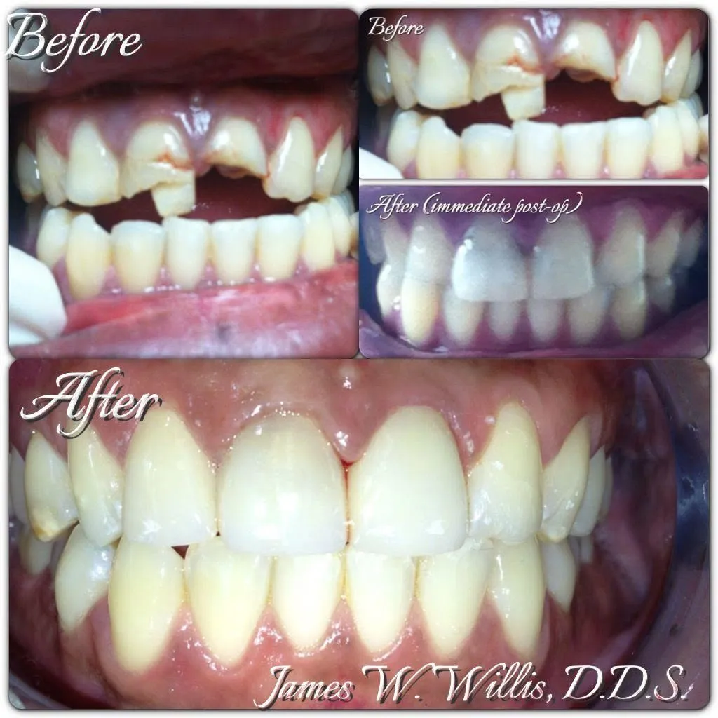 Before-and-after smile transformation — case 10, a cosmetic case treated by Dr. James Willis