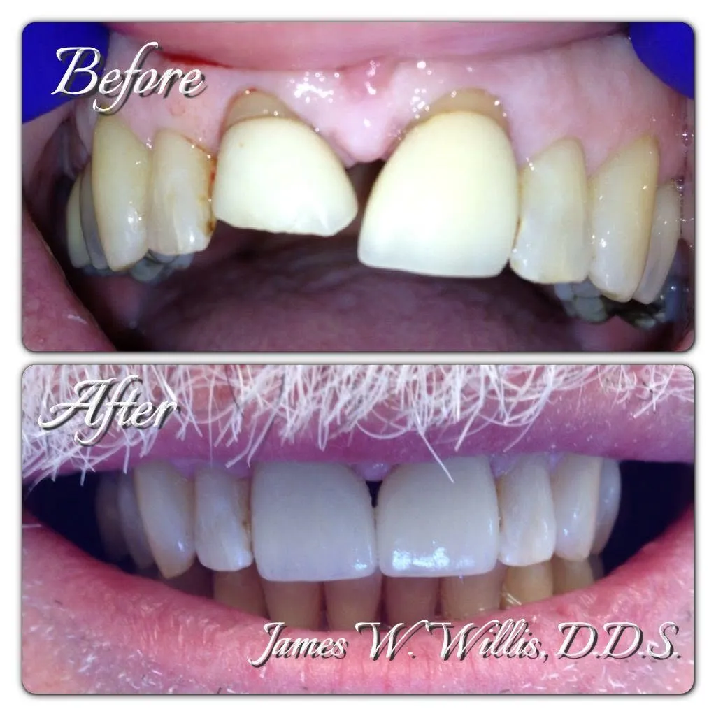 Before-and-after smile transformation — case 11, a cosmetic case treated by Dr. James Willis