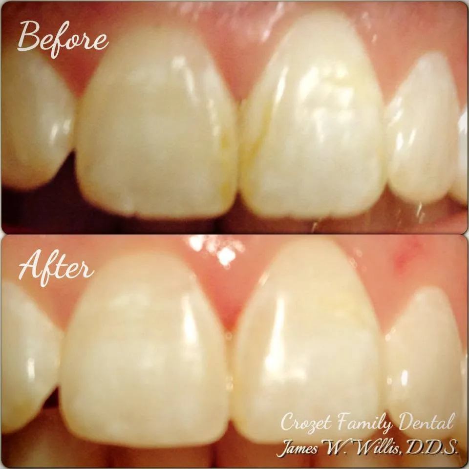 Before-and-after smile transformation — case 12, a cosmetic case treated by Dr. James Willis