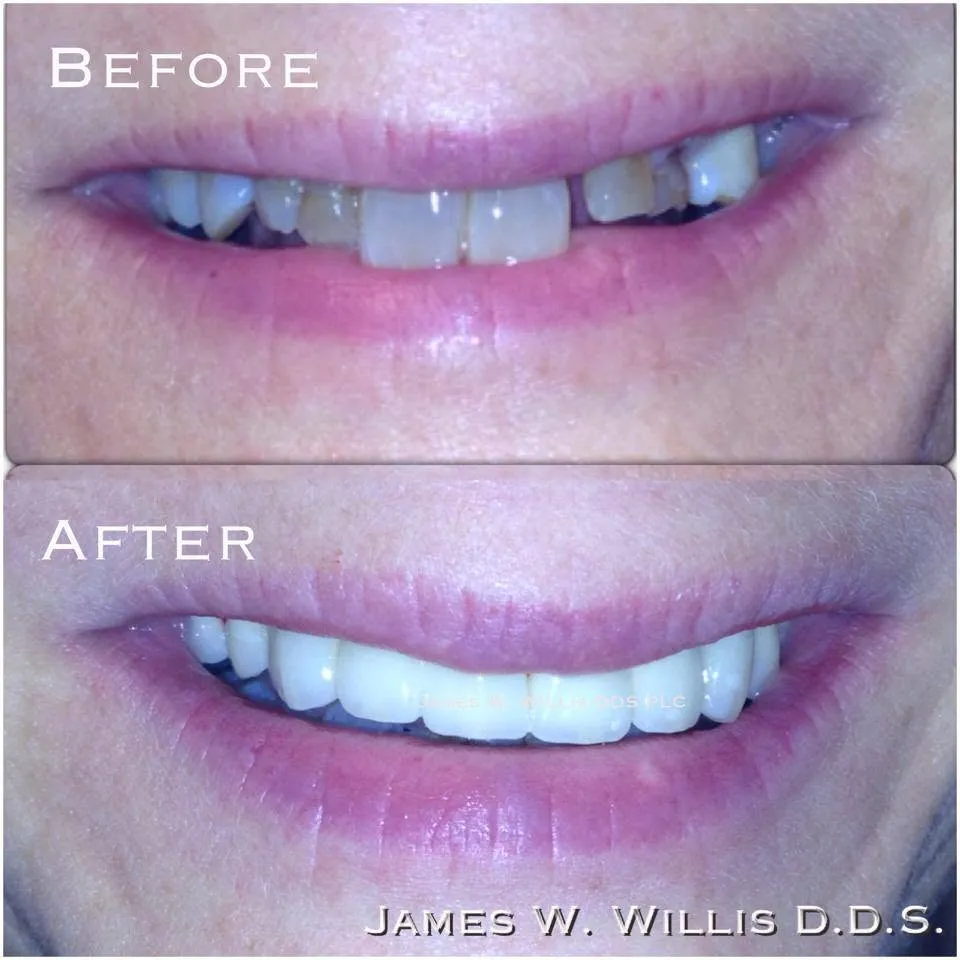 Before-and-after smile transformation — case 13, a cosmetic case treated by Dr. James Willis