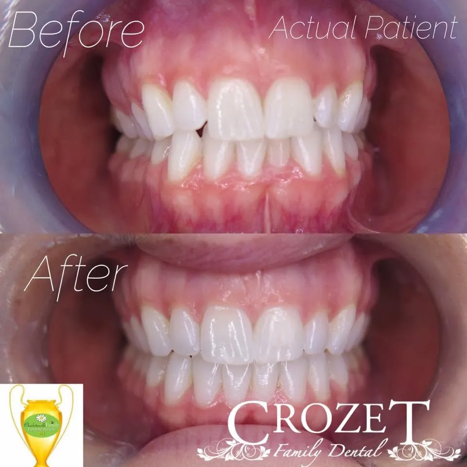 Before-and-after smile transformation — case 14, a cosmetic case treated by Dr. James Willis