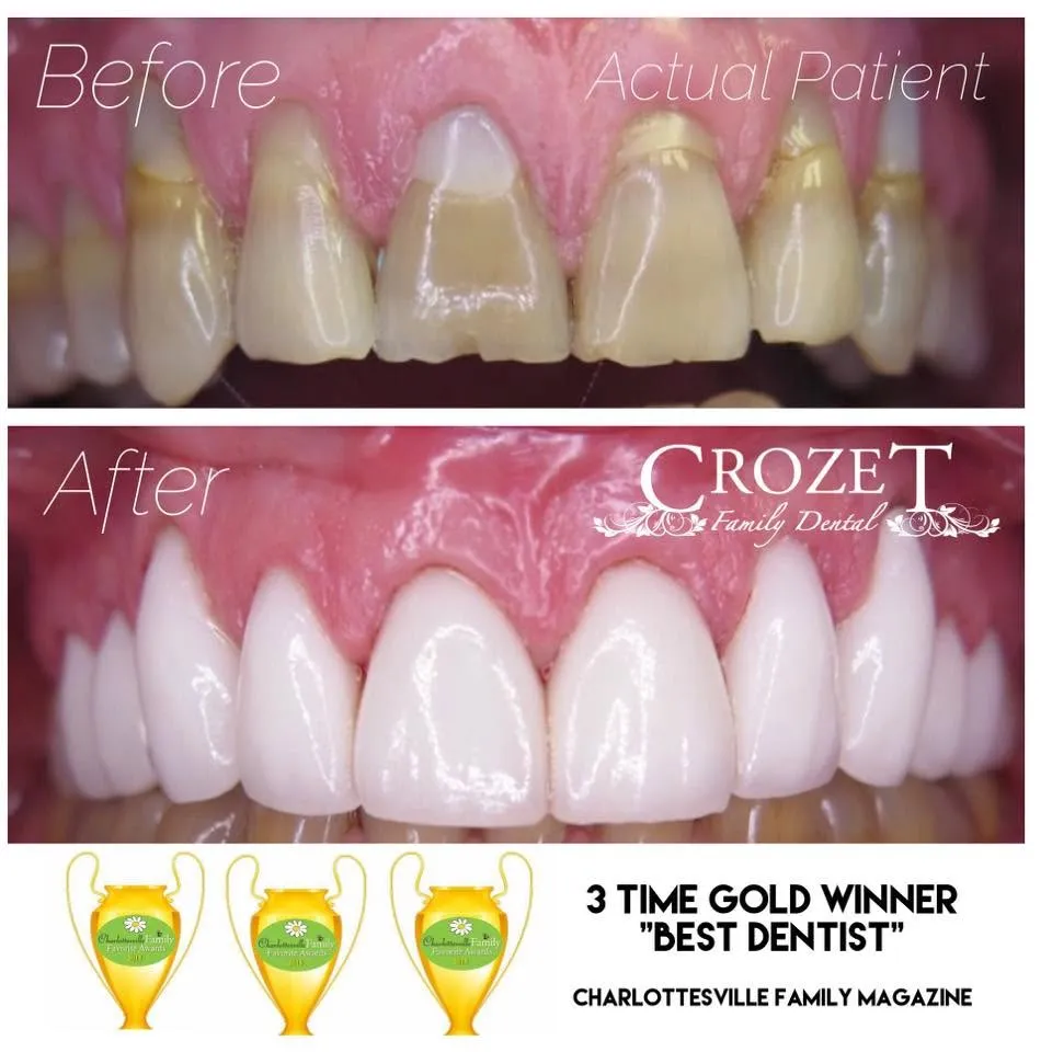 Before-and-after smile transformation — case 15, a cosmetic case treated by Dr. James Willis