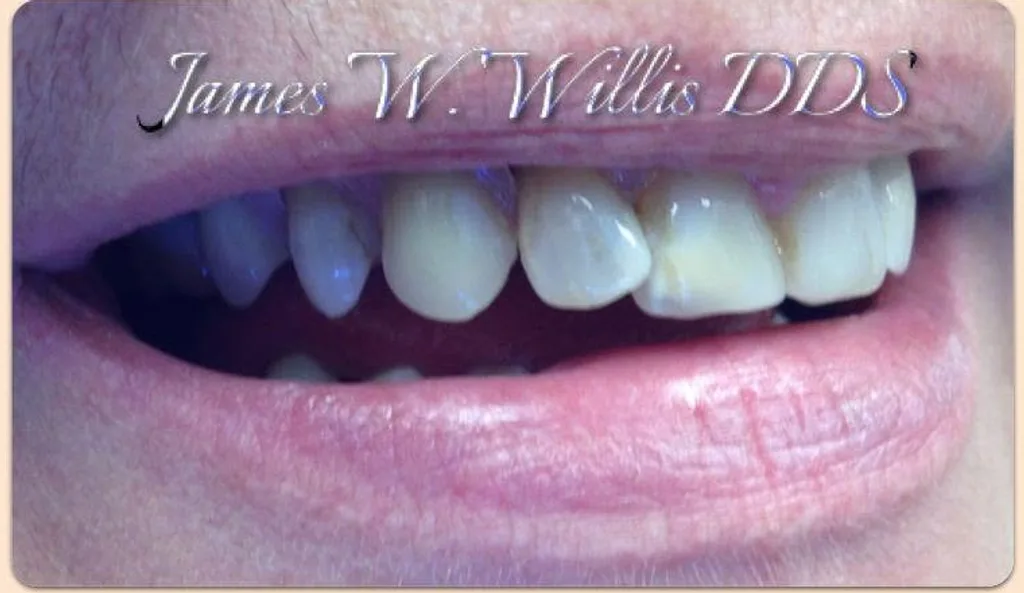 After: restored complete smile, treated by Dr. James Willis