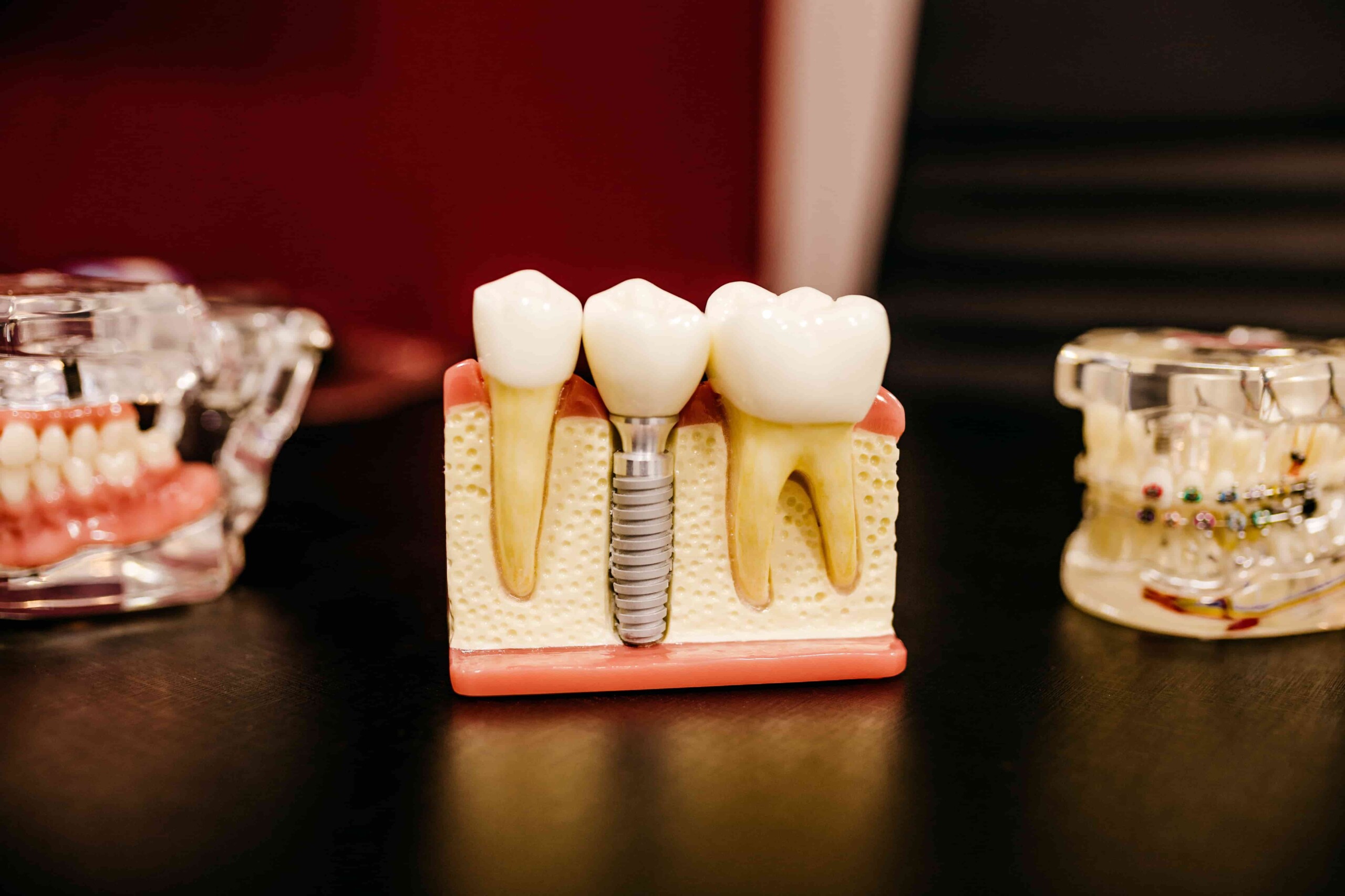 5 Reasons Why Dental Implants are the Ultimate Tooth Replacement Solution