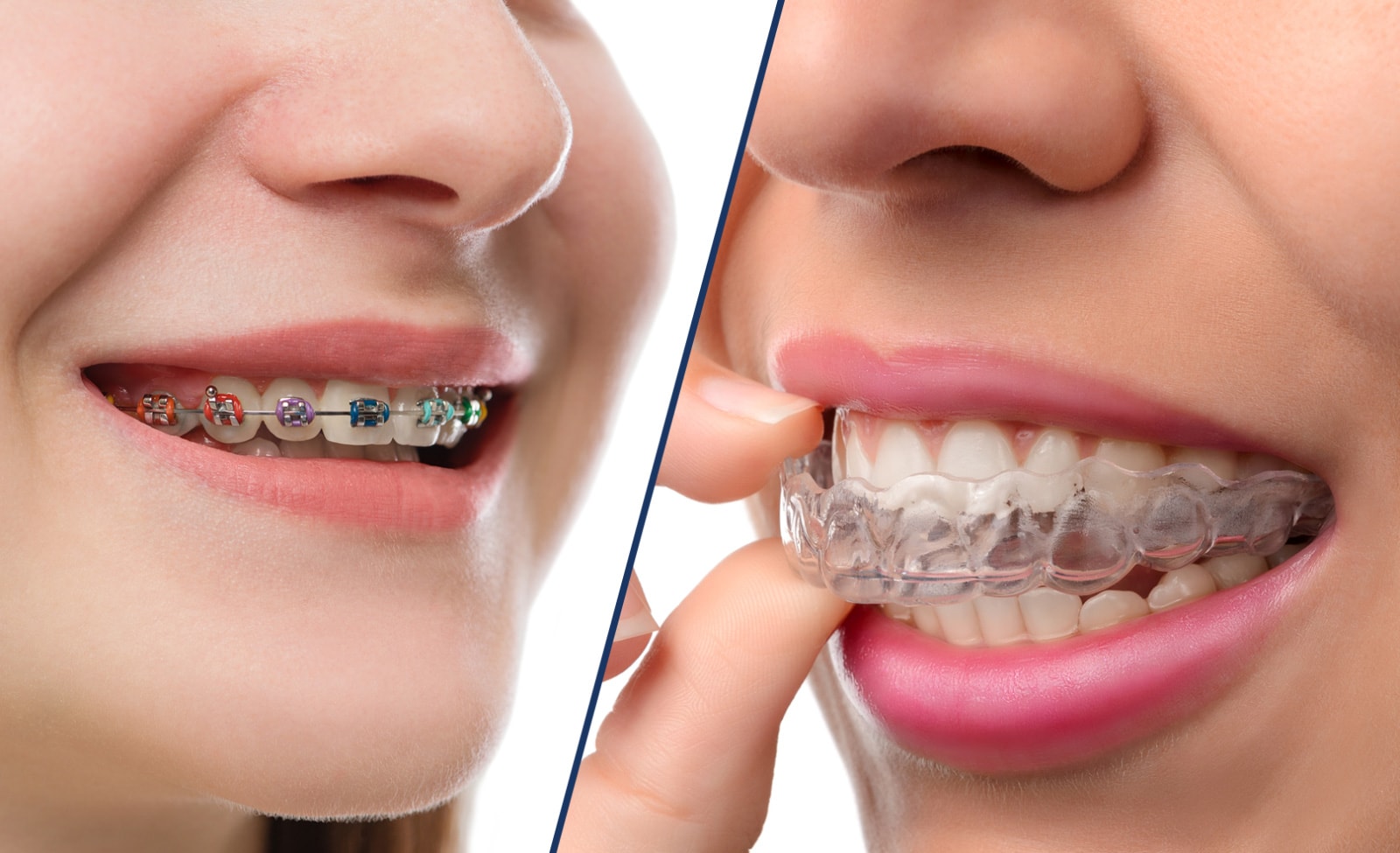 The Advantages of Invisalign Over Metal Braces