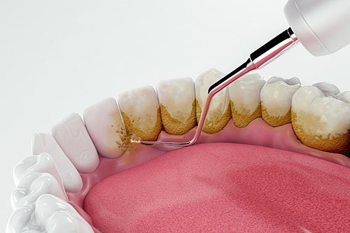 Unraveling the Mystery of Dental Plaque: A Microscopic Adventure