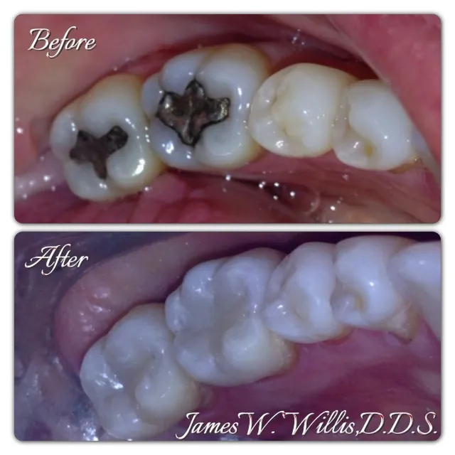 Before-and-after smile transformation — case 4, a cosmetic case treated by Dr. James Willis