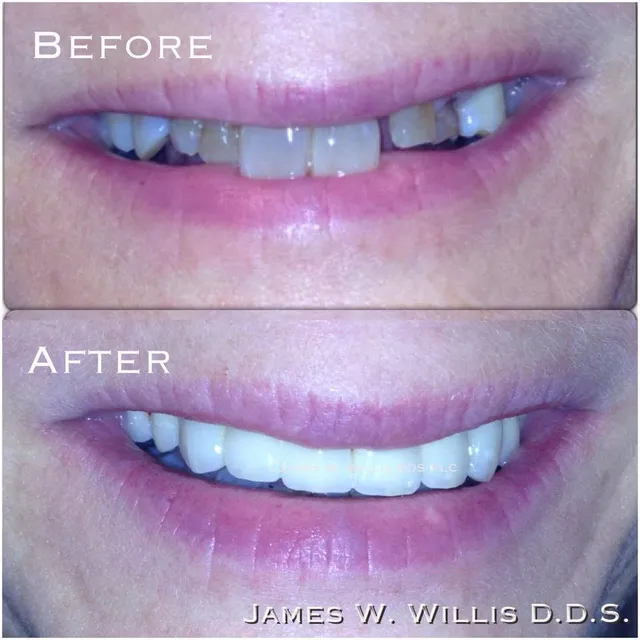 Before-and-after smile transformation — case 13, a cosmetic case treated by Dr. James Willis
