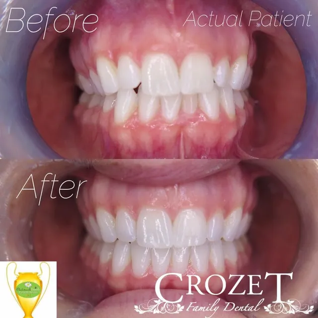 Before-and-after smile transformation — case 14, a cosmetic case treated by Dr. James Willis