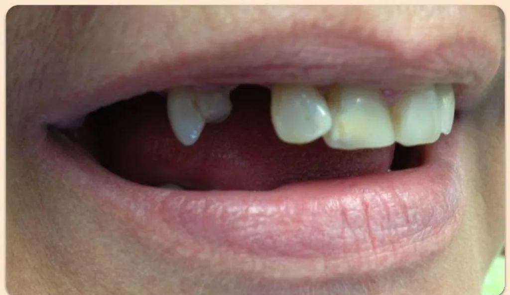 Before: smile with a missing front tooth, a cosmetic case treated by Dr. James Willis