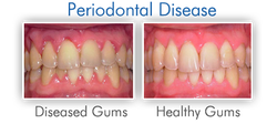 gum-disease