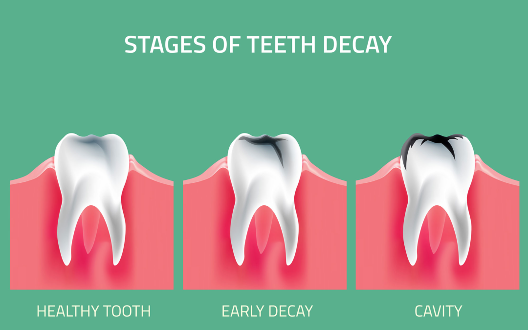 Wait, What Are Cavities… Actually?