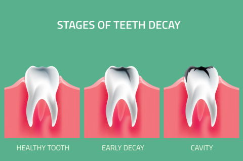 Wait, What Are Cavities... Actually? - Willis Family Dentistry