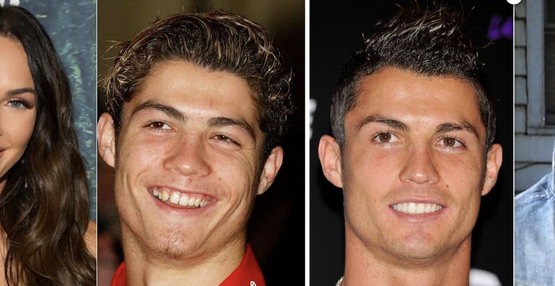 5 Amazing Celebrity Dental Transformations