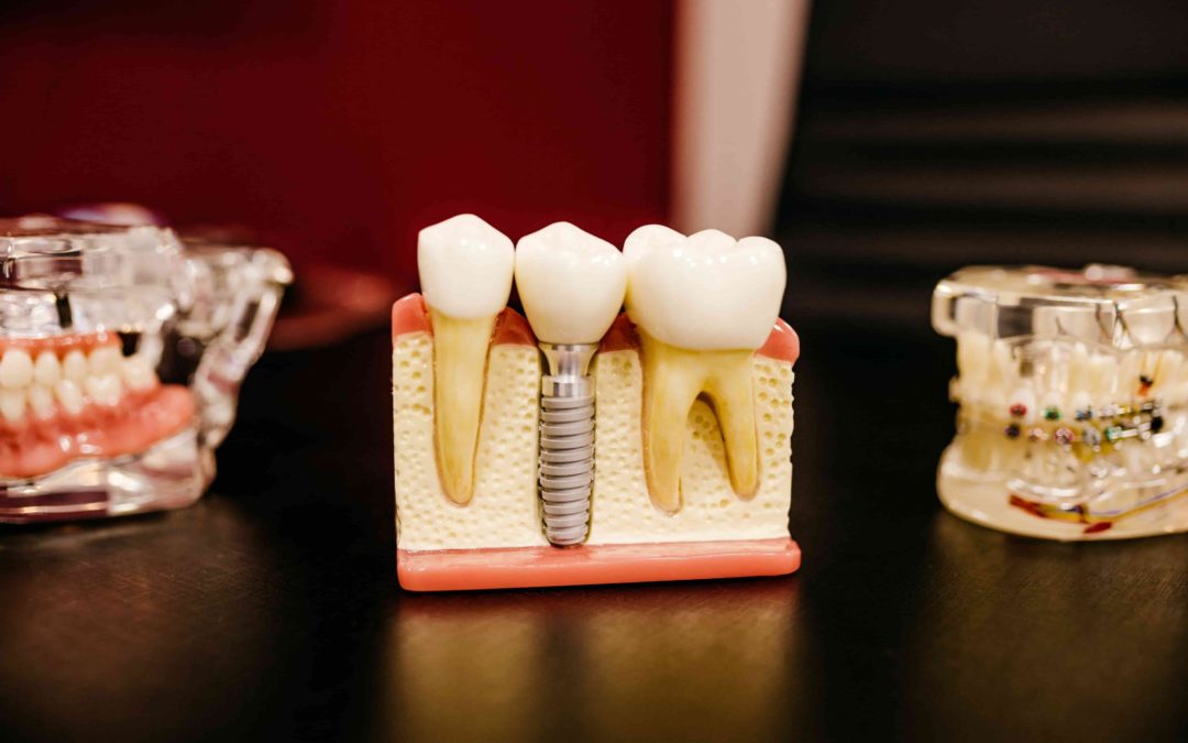 5 Reasons Why Dental Implants are the Ultimate Tooth Replacement Solution