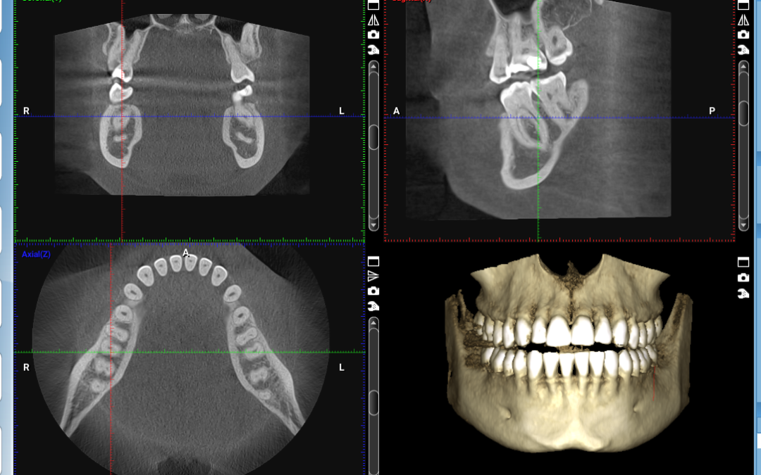 Revolutionizing Dental Implant Planning with CBCT Imaging
