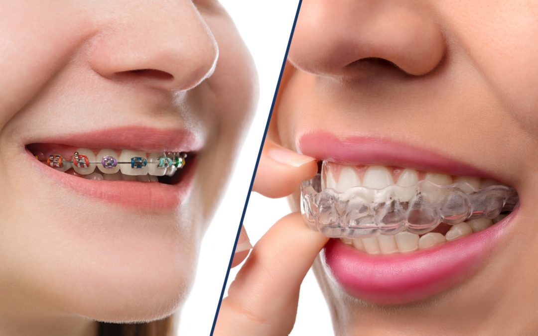 The Clear Choice: The Advantages of Invisalign Over Metal Braces