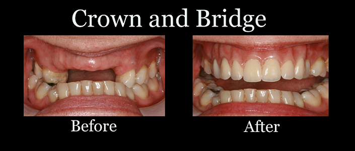 The Enigmatic Craftsmanship Behind Dental Bridges and Crowns